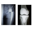JOINT REPLACEMENT SURGERY