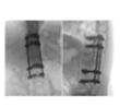 SPINE SURGERY